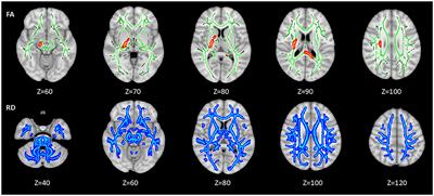 Characteristics of Brain White Matter Microstructure in HIV Male Patients With Primary Syphilis Co-Infection